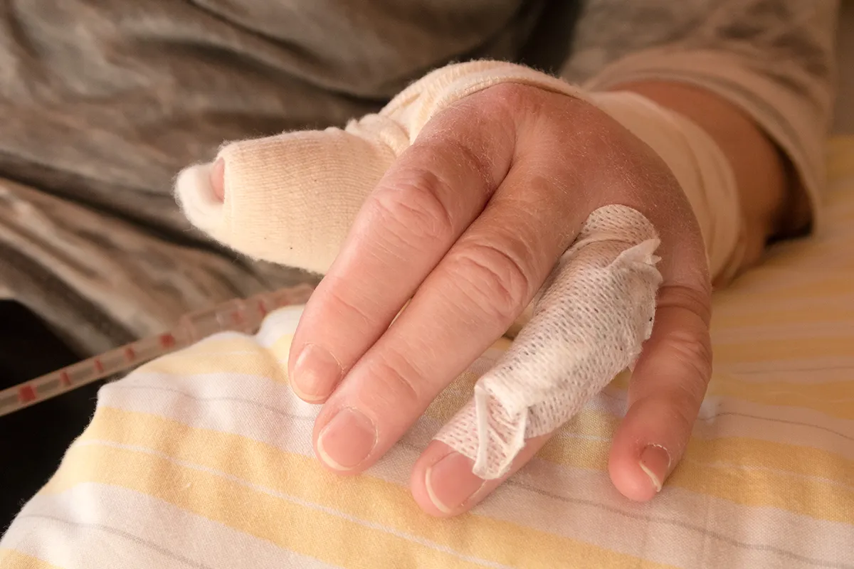 La rhizarthrose - Orthopédie du membre supérieur à Argonay