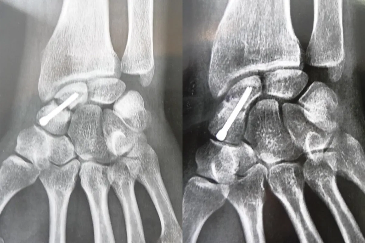 Pseudarthrose du Scaphoïde - Dr Nicolas Blanchet - Chirurgien orthopédique du membre supérieur à Argonay