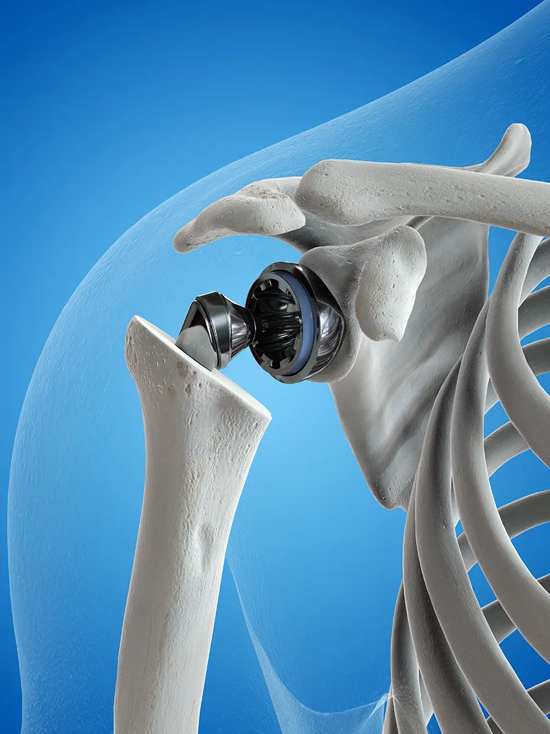 Arthrose de l'épaule - Dr Nicolas Blanchet, Chirurgie orthopédique à Argonay
