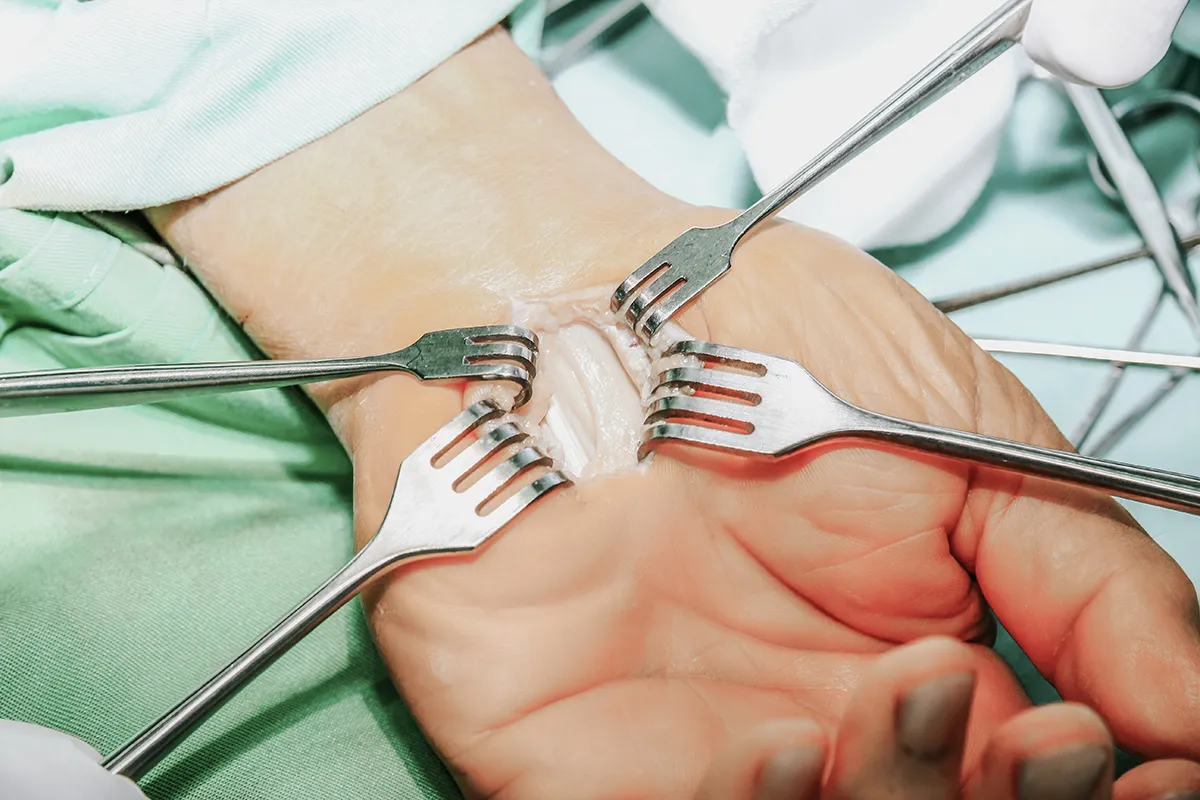 Arthrose radio carpienne - Dr Blanchet, orthopédiste à Argonay
