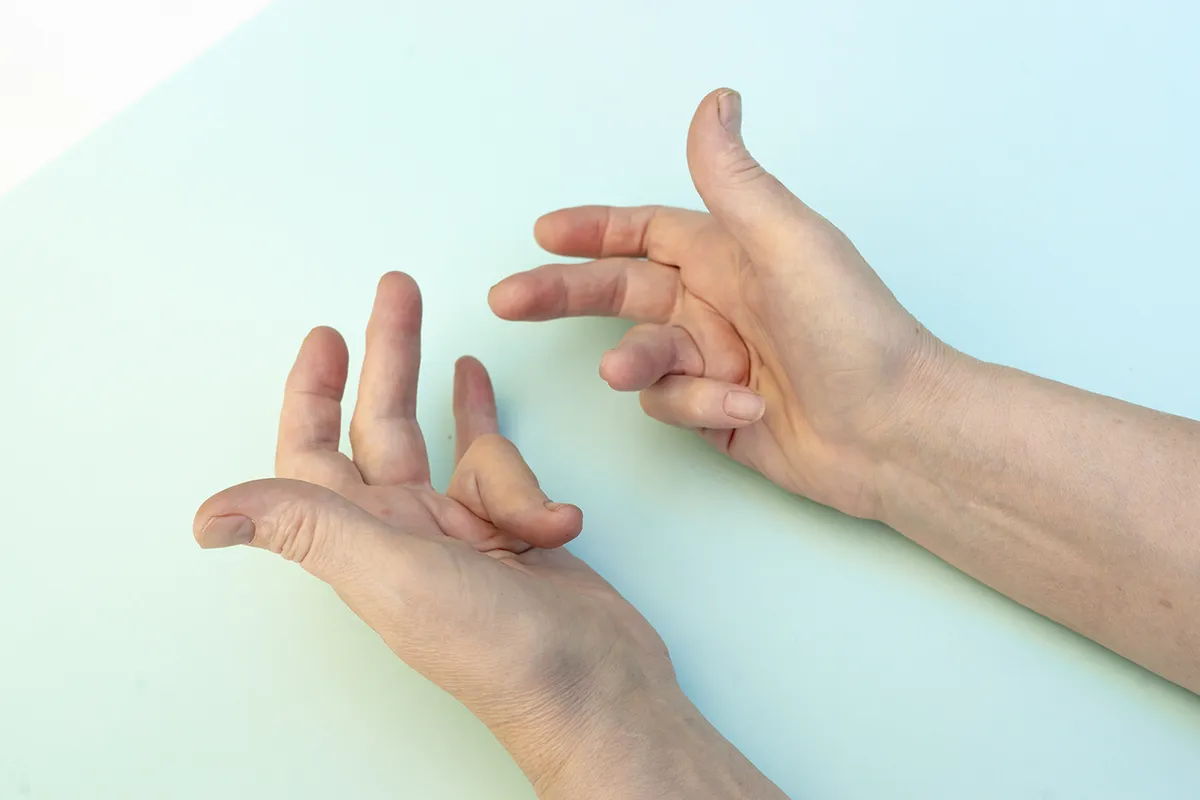 La maladie de Dupuytren - Orthopédie du membre supérieur à Argonay