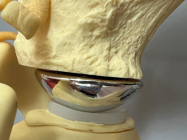 prothèse totale anatomique - Dr Blanchet, Chirurgien orthopédique à Annecy