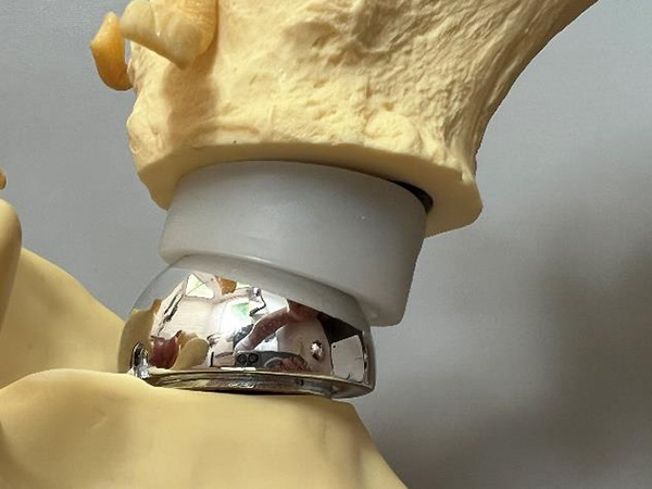 prothèse totale inversée - Dr Blanchet, Chirurgien orthopédique à Annecy