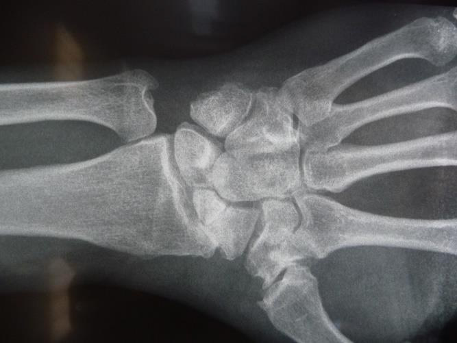 Arthrose suite pseudarthrose scaphoïde (SNAC)