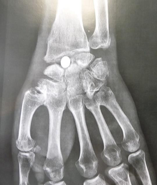 Remplacement partiel du scaphoïde par un implant libre (en pyrocarbone)