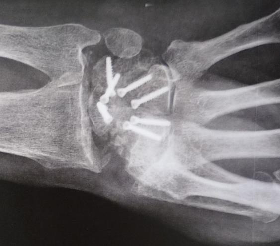 Arthrodèse des 4 os avec exérèse du scaphoïde en entier