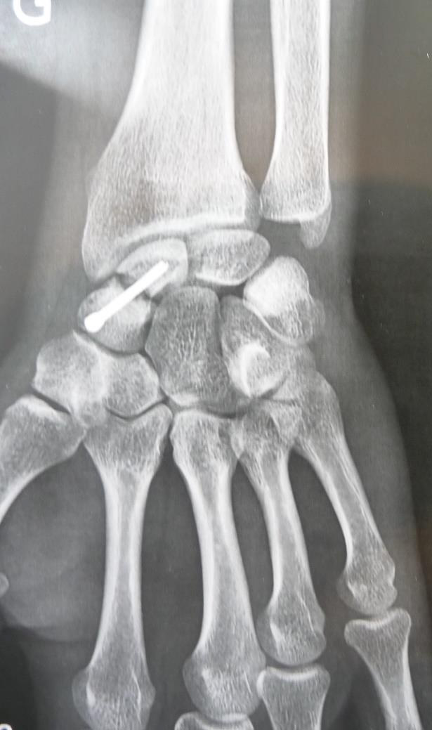 Pseudoarthrose du Scaphoide - Dr Nicolas Blanchet - Chirurgien orthopédique du membre supérieur à Argonay