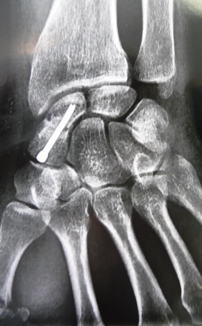 Pseudoarthrose du Scaphoide - Dr Nicolas Blanchet - Chirurgien orthopédique du membre supérieur à Argonay